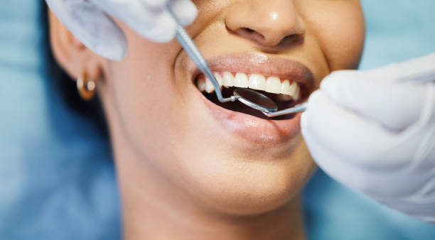 Best Emergency Wisdom Tooth Extraction in Boonville, IN