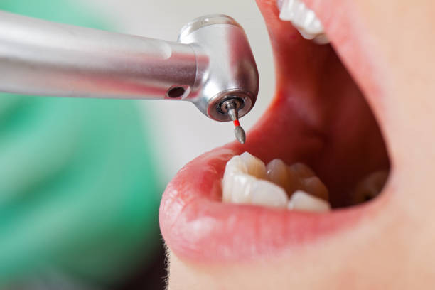Best Dental Abscess Treatment in Boonville, IN